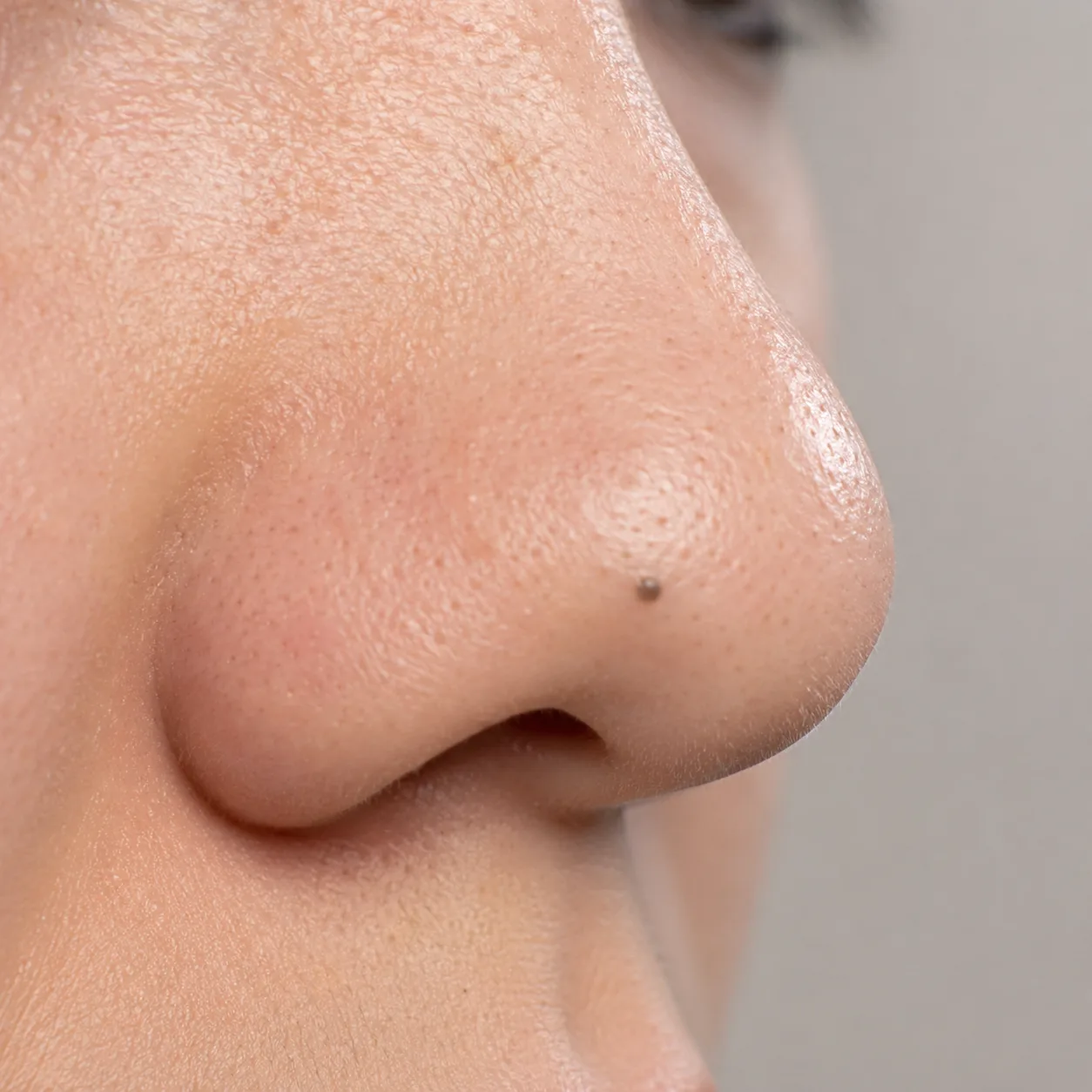 Blackheads on Nose